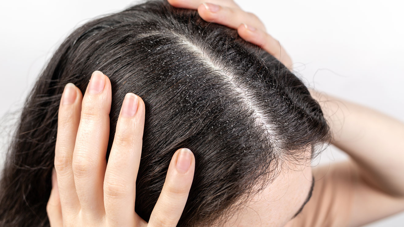 Falsche Haarpflege oder ein Ungleichgewicht in der Mikroflora der Kopfhaut können dazu führen, dass die Haut stark austrocknet und die Schuppen abstößt. - iStock/Ildar Abulkhanov